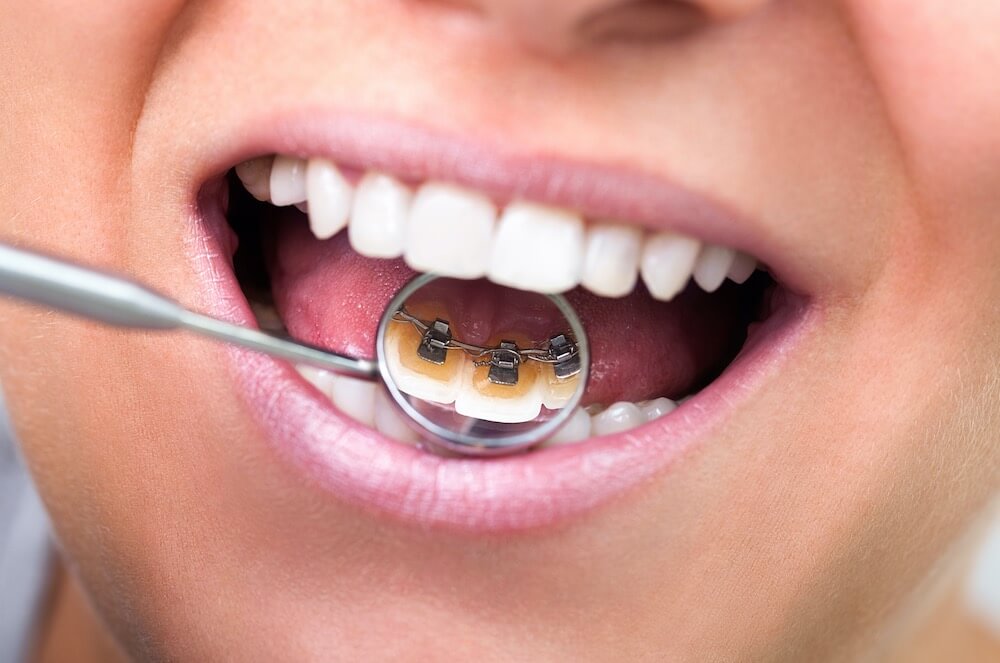 Lingual Brackets