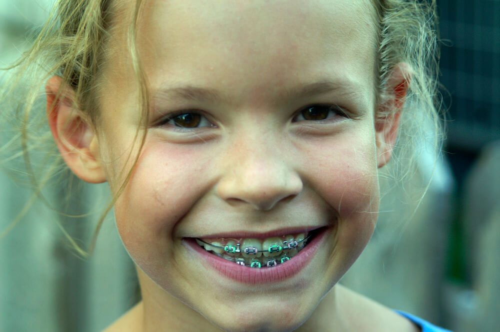 Metall Brackets